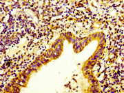 IHC image of CSB-PA011866LA01HU diluted at 1:400 and staining in paraffin-embedded human lung cancer performed on a Leica BondTM system. After dewaxing and hydration, antigen retrieval was mediated by high pressure in a citrate buffer (pH 6.0). Se...