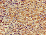 Immunohistochemistry of paraffin-embedded human liver cancer using CSB-PA011889LA01HU at dilution of 1:100