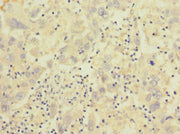 Immunohistochemistry of paraffin-embedded human liver cancer using CSB-PA011891ESR2HU at dilution of 1:100