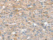 The image on the left is immunohistochemistry of paraffin-embedded Human liver cancer tissue using CSB-PA011961(SIK1 Antibody) at dilution 1/30, on the right is treated with synthetic peptide. (Original magnification: ×200)