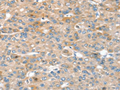 The image on the left is immunohistochemistry of paraffin-embedded Human liver cancer tissue using CSB-PA011961(SIK1 Antibody) at dilution 1/30, on the right is treated with synthetic peptide. (Original magnification: ×200)