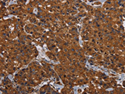 The image on the left is immunohistochemistry of paraffin-embedded Human breast cancer tissue using CSB-PA011966(HYAL2 Antibody) at dilution 1/60, on the right is treated with fusion protein. (Original magnification: ×200)