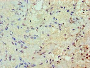 Immunohistochemistry of paraffin-embedded human breast cancer using CSB-PA011973DSR1HU at dilution of 1:100
