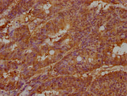 IHC image of CSB-PA011981LA01HU diluted at 1:100 and staining in paraffin-embedded human colon cancer performed on a Leica BondTM system. After dewaxing and hydration, antigen retrieval was mediated by high pressure in a citrate buffer (pH 6.0). S...