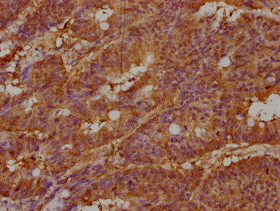 IHC image of CSB-PA011981LA01HU diluted at 1:100 and staining in paraffin-embedded human colon cancer performed on a Leica BondTM system. After dewaxing and hydration, antigen retrieval was mediated by high pressure in a citrate buffer (pH 6.0). S...