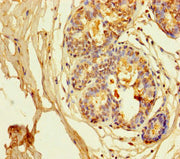 Immunohistochemistry of paraffin-embedded human breast cancer using CSB-PA012011LA01HU at dilution of 1:100