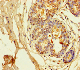 Immunohistochemistry of paraffin-embedded human breast cancer using CSB-PA012011LA01HU at dilution of 1:100