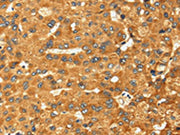 The image on the left is immunohistochemistry of paraffin-embedded Human liver cancer tissue using CSB-PA012032(RFFL Antibody) at dilution 1/25, on the right is treated with fusion protein. (Original magnification: ×200)