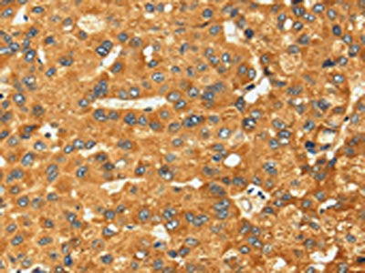 The image on the left is immunohistochemistry of paraffin-embedded Human liver cancer tissue using CSB-PA012032(RFFL Antibody) at dilution 1/25, on the right is treated with fusion protein. (Original magnification: ×200)