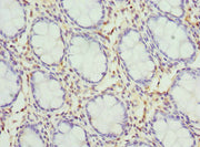 Immunohistochemistry of paraffin-embedded human colon cancer using CSB-PA012035DSR2HU at dilution of 1:100