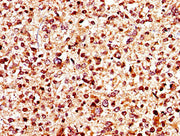 IHC image of CSB-PA012048LA01HU diluted at 1:400 and staining in paraffin-embedded human glioma performed on a Leica BondTM system. After dewaxing and hydration, antigen retrieval was mediated by high pressure in a citrate buffer (pH 6.0). Section...