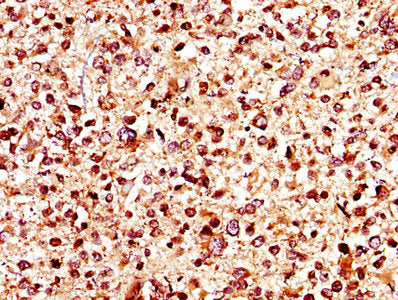 IHC image of CSB-PA012048LA01HU diluted at 1:400 and staining in paraffin-embedded human glioma performed on a Leica BondTM system. After dewaxing and hydration, antigen retrieval was mediated by high pressure in a citrate buffer (pH 6.0). Section...