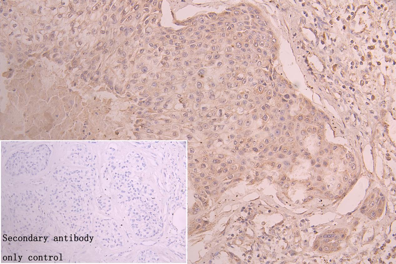 IHC image of CSB-PA012149ESR1HU diluted at 1:50 and staining in paraffin-embedded human pancreatic cancer performed on a Leica BondTM system. After dewaxing and hydration, antigen retrieval was mediated by high pressure in a citrate buffer (pH 6.0...