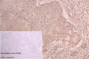 IHC image of CSB-PA012149ESR1HU diluted at 1:50 and staining in paraffin-embedded human pancreatic cancer performed on a Leica BondTM system. After dewaxing and hydration, antigen retrieval was mediated by high pressure in a citrate buffer (pH 6.0...