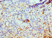 Immunohistochemistry of paraffin-embedded human lung cancer using CSB-PA012203ESR1HU at dilution of 1:100
