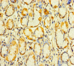 Immunohistochemistry of paraffin-embedded human gastric cancer using CSB-PA012251LA01HU at dilution of 1:100