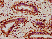 IHC image of CSB-PA012267LA01HU diluted at 1:400 and staining in paraffin-embedded human breast cancer performed on a Leica BondTM system. After dewaxing and hydration, antigen retrieval was mediated by high pressure in a citrate buffer (pH 6.0)....