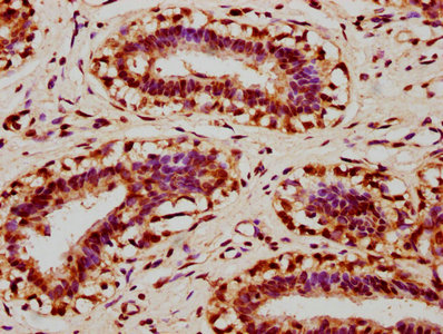 IHC image of CSB-PA012267LA01HU diluted at 1:400 and staining in paraffin-embedded human breast cancer performed on a Leica BondTM system. After dewaxing and hydration, antigen retrieval was mediated by high pressure in a citrate buffer (pH 6.0)....