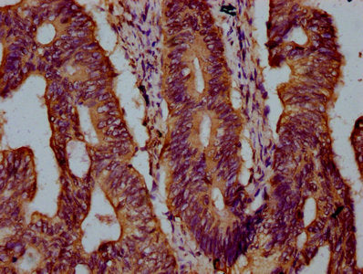 IHC image of CSB-PA012324LA01HU diluted at 1:300 and staining in paraffin-embedded human colon cancer performed on a Leica BondTM system. After dewaxing and hydration, antigen retrieval was mediated by high pressure in a citrate buffer (pH 6.0). S...