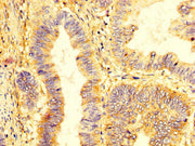 IHC image of CSB-PA012352LA01HU diluted at 1:400 and staining in paraffin-embedded human colon cancer performed on a Leica BondTM system. After dewaxing and hydration, antigen retrieval was mediated by high pressure in a citrate buffer (pH 6.0). S...