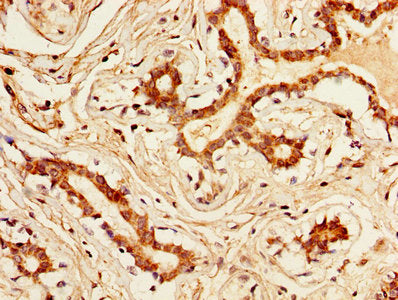 IHC image of CSB-PA012446LA01HU diluted at 1:300 and staining in paraffin-embedded human breast cancer performed on a Leica BondTM system. After dewaxing and hydration, antigen retrieval was mediated by high pressure in a citrate buffer (pH 6.0)....