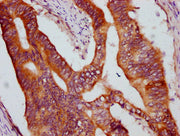IHC image of CSB-PA012501LA01HU diluted at 1:600 and staining in paraffin-embedded human colon cancer performed on a Leica BondTM system. After dewaxing and hydration, antigen retrieval was mediated by high pressure in a citrate buffer (pH 6.0). S...