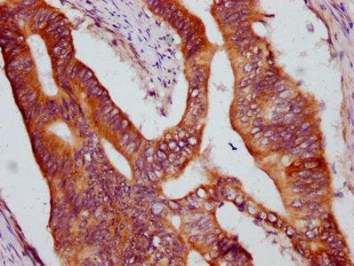 IHC image of CSB-PA012501LA01HU diluted at 1:600 and staining in paraffin-embedded human colon cancer performed on a Leica BondTM system. After dewaxing and hydration, antigen retrieval was mediated by high pressure in a citrate buffer (pH 6.0). S...