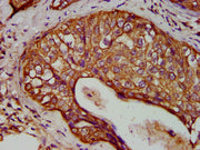 IHC image of CSB-PA012503LA01HU diluted at 1:400 and staining in paraffin-embedded human cervical cancer performed on a Leica BondTM system. After dewaxing and hydration, antigen retrieval was mediated by high pressure in a citrate buffer (pH 6.0)...