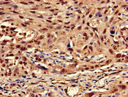 Immunohistochemistry of paraffin-embedded human lung cancer using CSB-PA012511LA01HU at dilution of 1:100