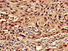 Immunohistochemistry of paraffin-embedded human lung cancer using CSB-PA012511LA01HU at dilution of 1:100