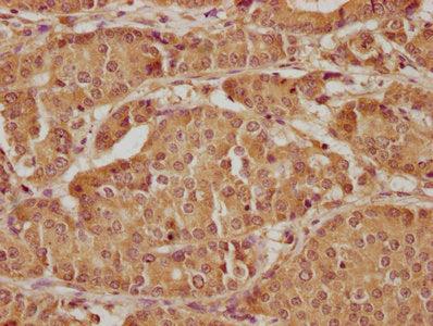 IHC image of CSB-PA012536LA01HU diluted at 1:300 and staining in paraffin-embedded human gastric cancer performed on a Leica BondTM system. After dewaxing and hydration, antigen retrieval was mediated by high pressure in a citrate buffer (pH 6.0)....