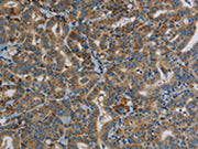 The image on the left is immunohistochemistry of paraffin-embedded Human thyroid cancer tissue using CSB-PA012670(PPARGC1B Antibody) at dilution 1/30, on the right is treated with synthetic peptide. (Original magnification: ×200)