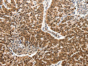 The image on the left is immunohistochemistry of paraffin-embedded Human lung cancer tissue using CSB-PA012674(CCL2 Antibody) at dilution 1/50, on the right is treated with synthetic peptide. (Original magnification: ×200)