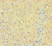 Immunohistochemistry of paraffin-embedded human liver cancer using CSB-PA012722LA01HU at dilution of 1:100