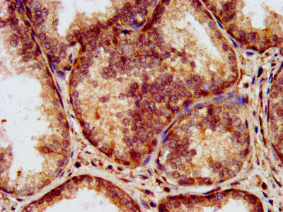 IHC image of CSB-PA012726LA01HU diluted at 1:200 and staining in paraffin-embedded human prostate cancer performed on a Leica BondTM system. After dewaxing and hydration, antigen retrieval was mediated by high pressure in a citrate buffer (pH 6.0)...