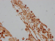 IHC image of CSB-PA012734LA01HU diluted at 1:100 and staining in paraffin-embedded human melanoma cancer performed on a Leica BondTM system. After dewaxing and hydration, antigen retrieval was mediated by high pressure in a citrate buffer (pH 6.0)...