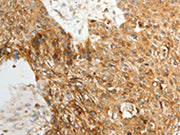 The image on the left is immunohistochemistry of paraffin-embedded Human esophagus cancer tissue using CSB-PA012753(TENM3 Antibody) at dilution 1/50, on the right is treated with synthetic peptide. (Original magnification: ×200)