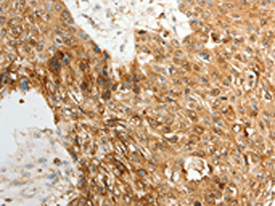 The image on the left is immunohistochemistry of paraffin-embedded Human esophagus cancer tissue using CSB-PA012753(TENM3 Antibody) at dilution 1/50, on the right is treated with synthetic peptide. (Original magnification: ×200)