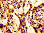Immunohistochemistry of paraffin-embedded human gastric cancer using CSB-PA012775LA01HU at dilution of 1:100