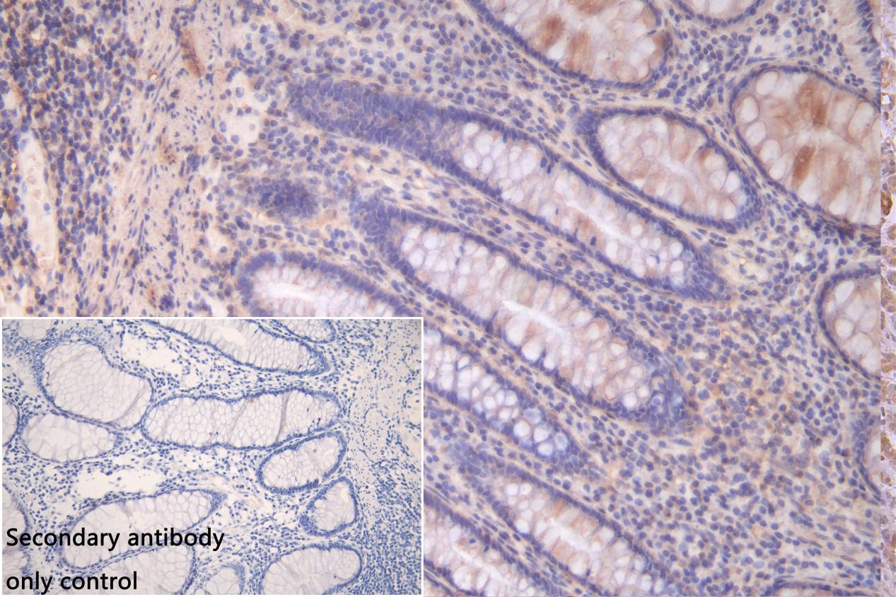 Immunohistochemistry of paraffin-embedded human lung cancer using CSB-PA012827LA01HU at dilution of 1:100