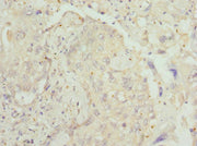 Immunohistochemistry of paraffin-embedded human lung cancer using CSB-PA012854ESR1HU at dilution of 1:100