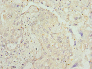 Immunohistochemistry of paraffin-embedded human lung cancer using CSB-PA012854ESR1HU at dilution of 1:100