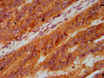 IHC image of CSB-PA012855LA01HU diluted at 1:400 and staining in paraffin-embedded human endometrial cancer performed on a Leica BondTM system. After dewaxing and hydration, antigen retrieval was mediated by high pressure in a citrate buffer (pH 6...