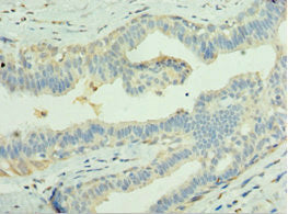 Immunohistochemistry of paraffin-embedded human breast cancer using CSB-PA012898ESR2HU at dilution of 1: 100