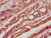 IHC image of CSB-PA012906LA01HU diluted at 1:400 and staining in paraffin-embedded human colon cancer performed on a Leica BondTM system. After dewaxing and hydration, antigen retrieval was mediated by high pressure in a citrate buffer (pH 6.0). S...