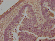 IHC image of CSB-PA012943LA01HU diluted at 1:100 and staining in paraffin-embedded human ovarian cancer performed on a Leica BondTM system. After dewaxing and hydration, antigen retrieval was mediated by high pressure in a citrate buffer (pH 6.0)....