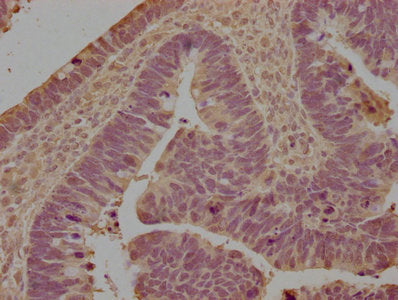 IHC image of CSB-PA012943LA01HU diluted at 1:100 and staining in paraffin-embedded human ovarian cancer performed on a Leica BondTM system. After dewaxing and hydration, antigen retrieval was mediated by high pressure in a citrate buffer (pH 6.0)....