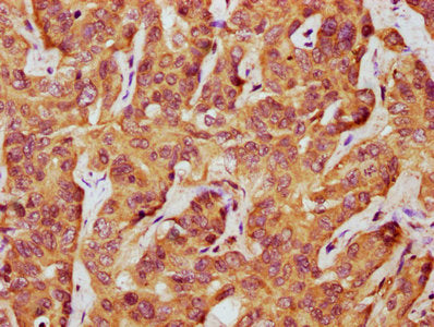 IHC image of CSB-PA012950LA01HU diluted at 1:500 and staining in paraffin-embedded human liver cancer performed on a Leica BondTM system. After dewaxing and hydration, antigen retrieval was mediated by high pressure in a citrate buffer (pH 6.0). S...