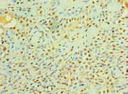 Immunohistochemistry of paraffin-embedded human breast cancer using CSB-PA012953ESR1HU at dilution of 1:100