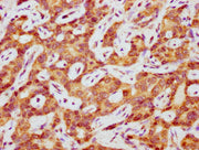 IHC image of CSB-PA012974LA01HU diluted at 1:400 and staining in paraffin-embedded human liver cancer performed on a Leica BondTM system. After dewaxing and hydration, antigen retrieval was mediated by high pressure in a citrate buffer (pH 6.0). S...